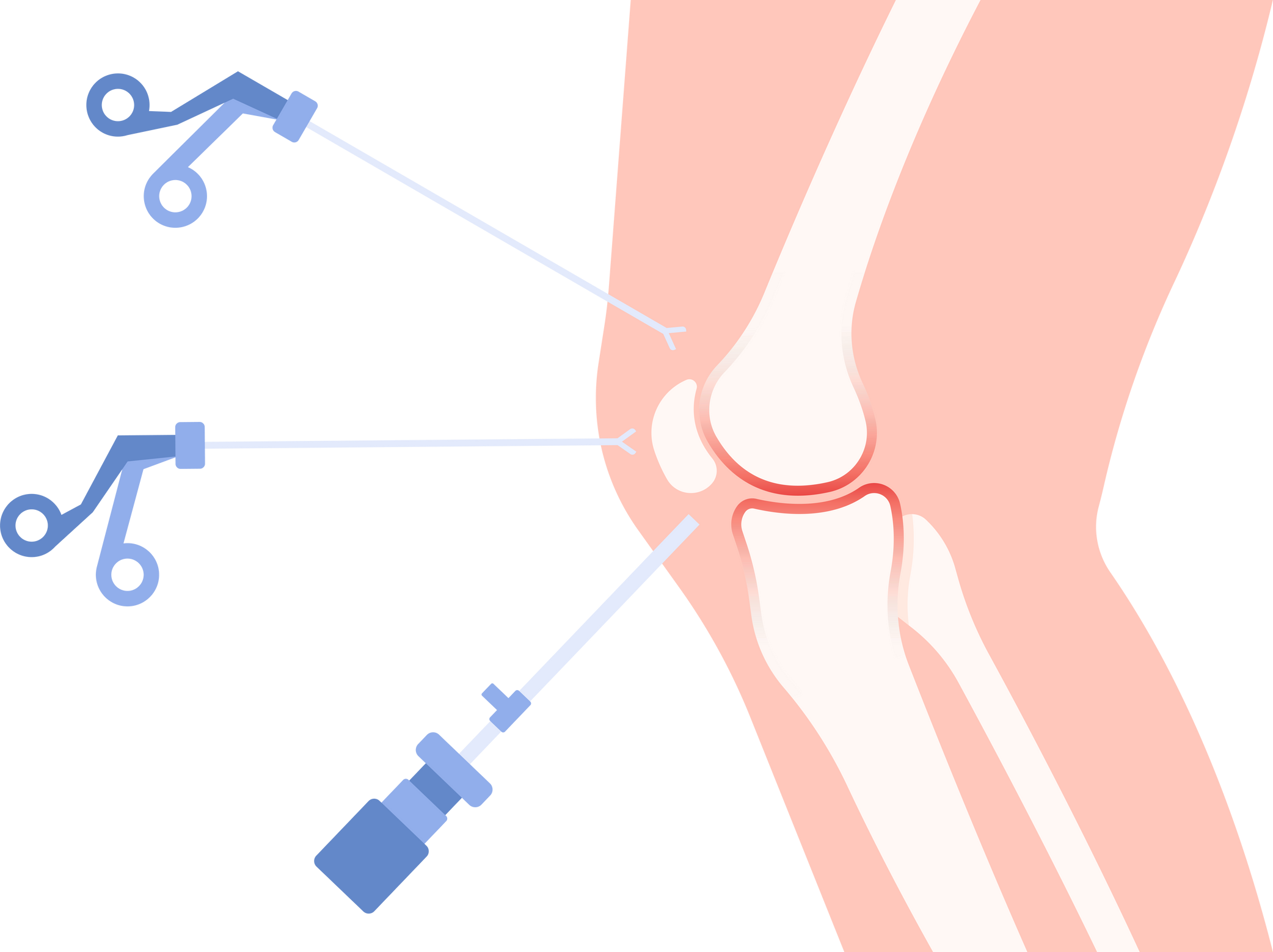 Torn bone ACL repair patella cartilage bursitis Total knee Tear Joint Pain Injury Surgery Implant Medical kneecap Keyhole invasive Anatomy